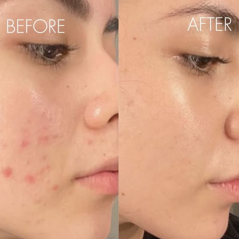 Acne treatment before and after, client 1
