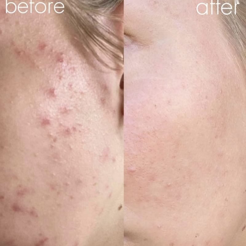 Acne treatment before and after, client 2