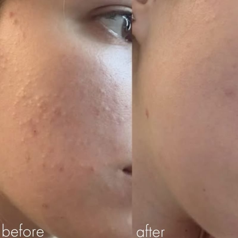 Acne treatment before and after, client 3